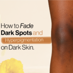 How to fade dark spots and hyperpigmentation on dark skin